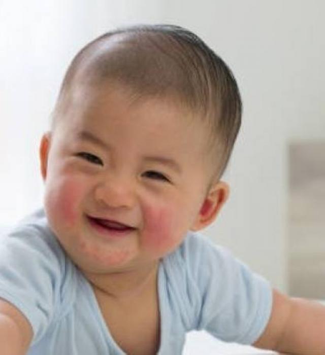 Eczema Conference 2025